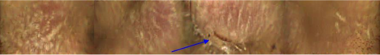 CaseStudy3_Img1_Irregular gastric mucosa with erosion
